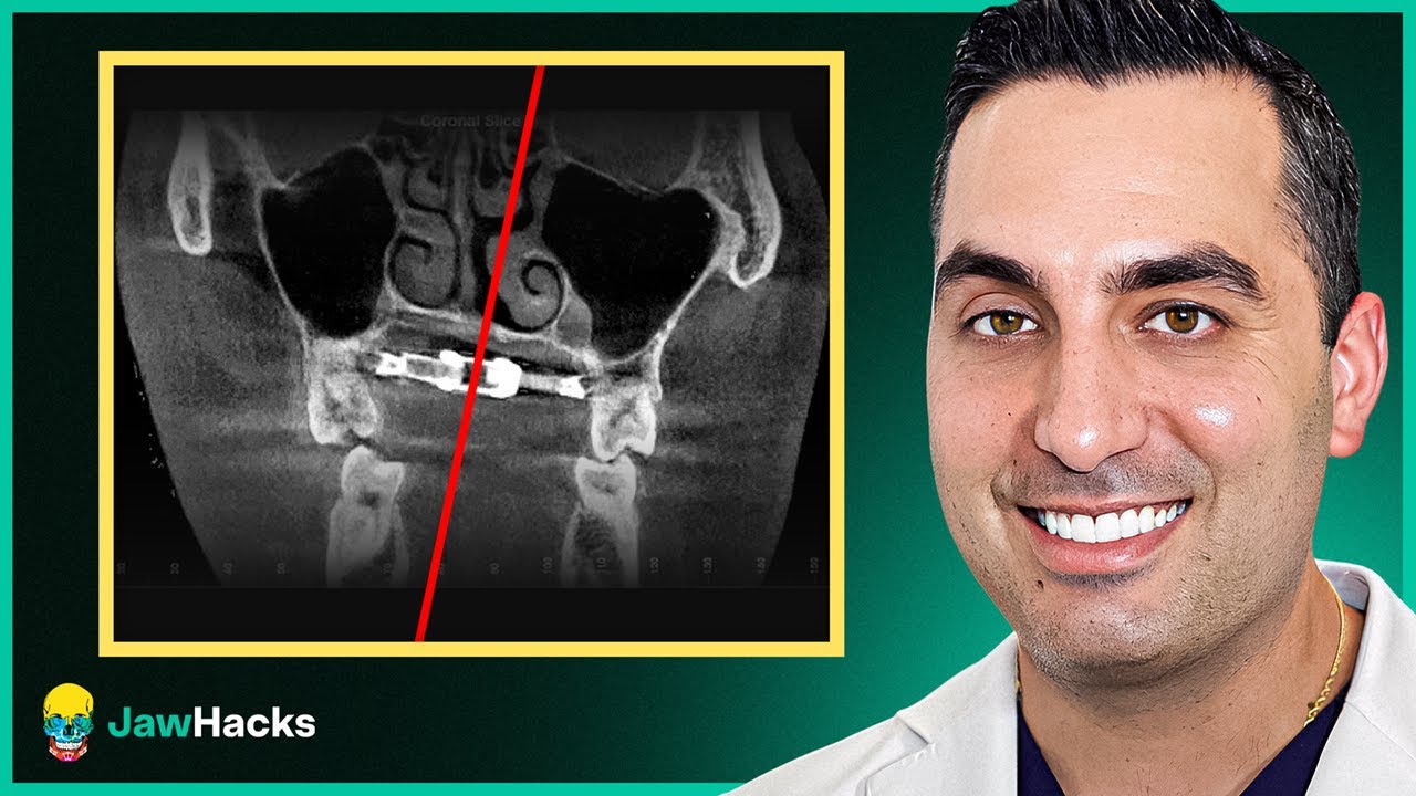 How to Avoid MARPE Asymmetry Complications