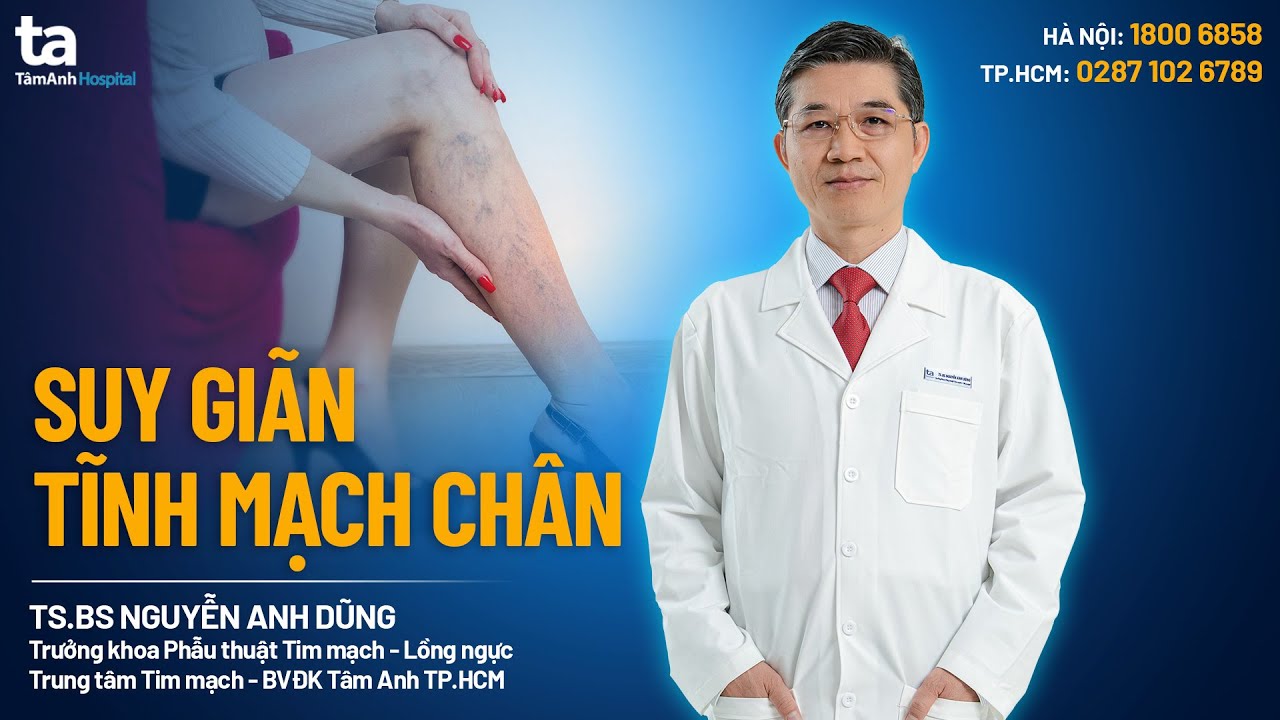Suy giãn tĩnh mạch chân (chi dưới) là gì? Nguyên nhân, dấu hiệu và cách điều trị | Tâm Anh