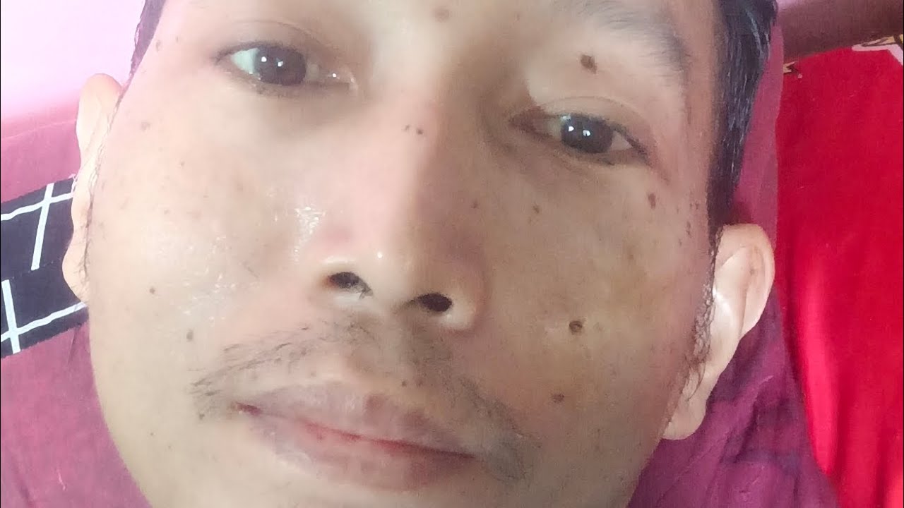 Sharing tentang pengalaman sakit pasca operasi ambeien dan timbul penyakit baru yaitu kantung kemih