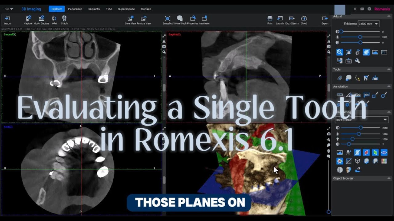 Evaluating a Single Tooth in Romexis 6.1