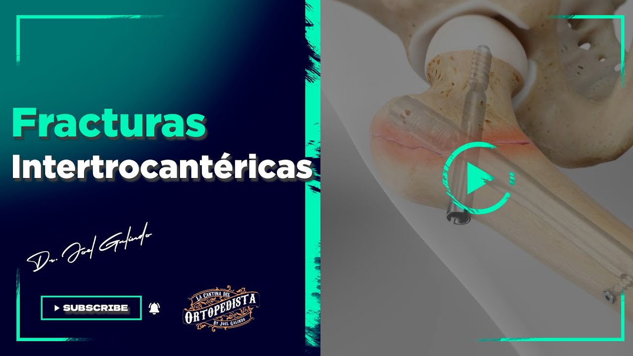 Fracturas intertrocantéricas