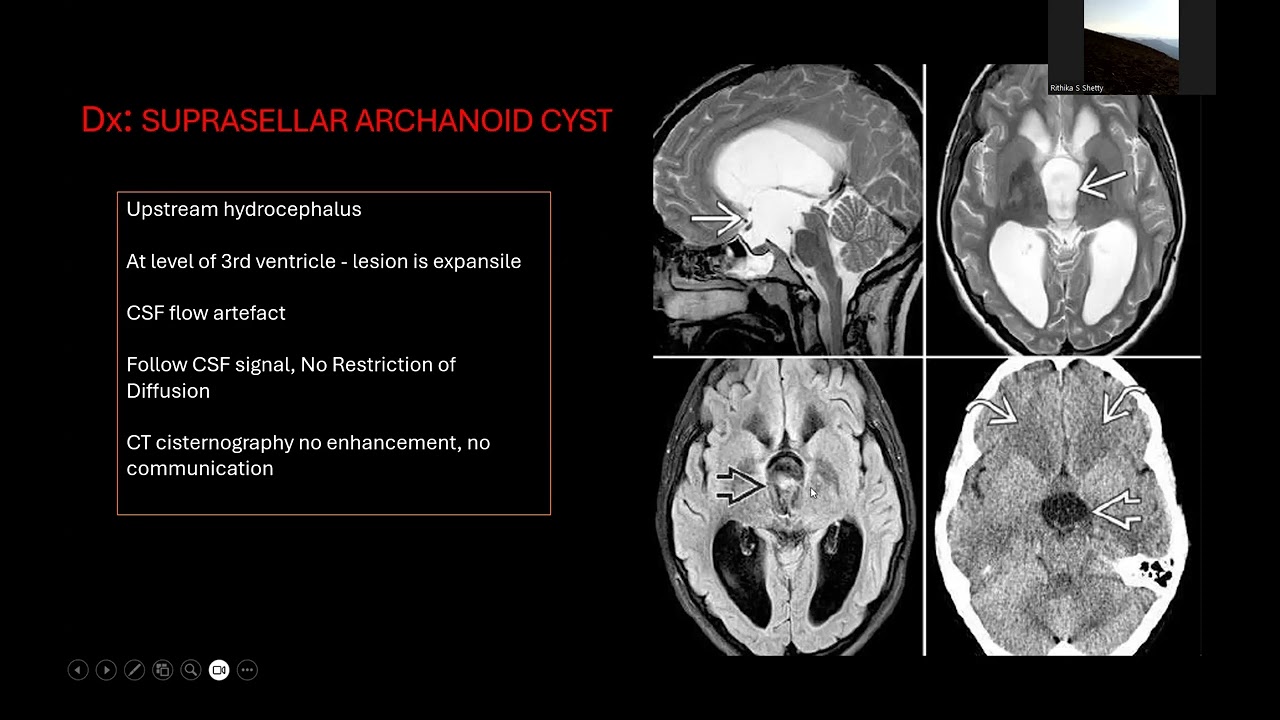Approach to intracranial cyst -radiology 