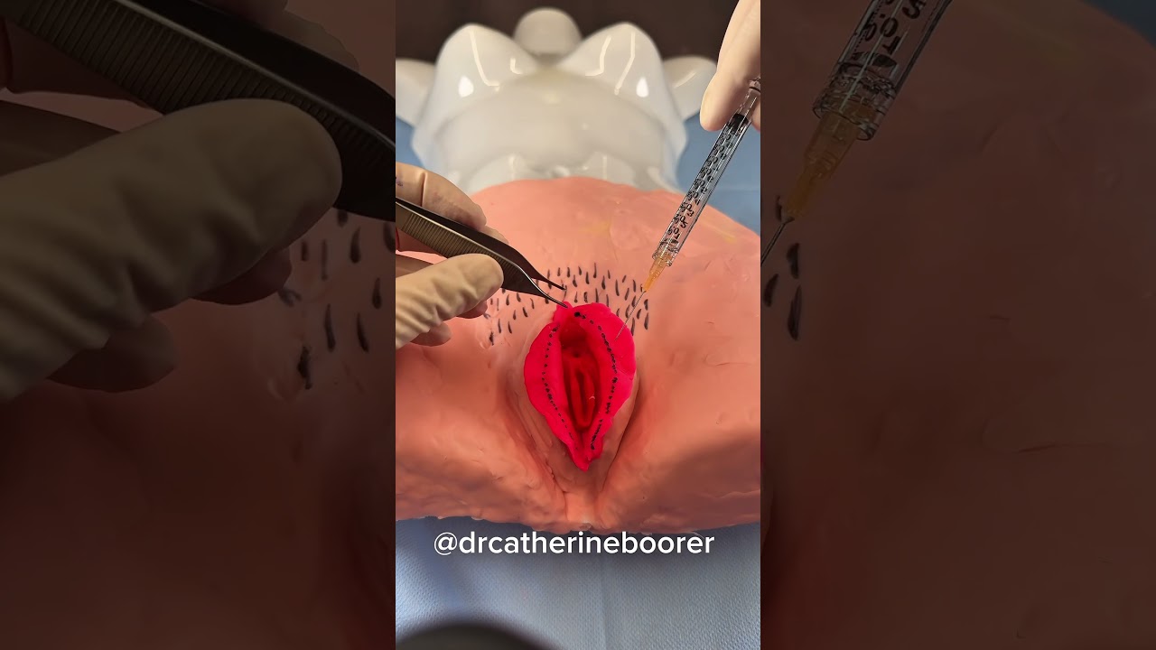 Plastic Surgeon performs Labiaplasty surgery using Play-Doh #plasticsurgery