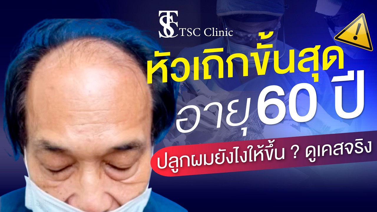 หัวเถิกขั้นสุด ผมบางระดับสูง อายุ 60+ ปลูกผมได้ไหม?
