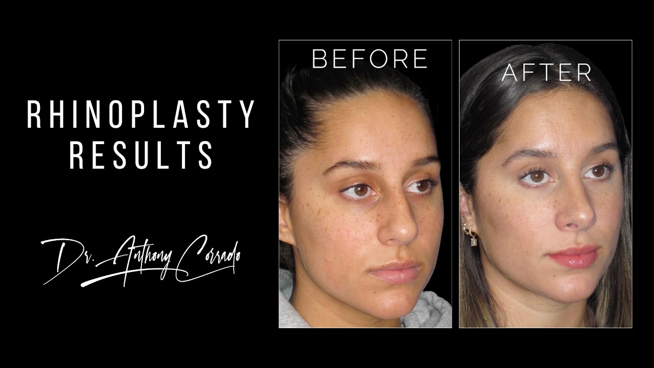 Stunning Nose Job: Before & After Rhinoplasty Reveal | Dr. Anthony Corrado