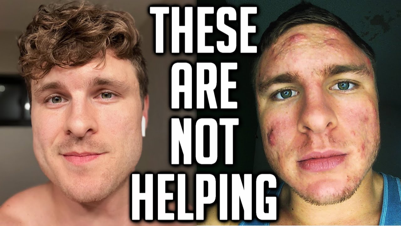 5 Things That Actually Make Your Acne Way Worse!