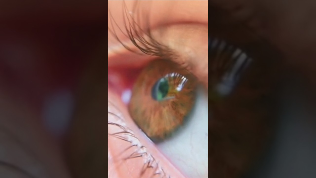 Eye floaters 😱😱 