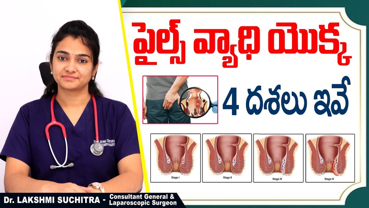 పైల్స్ యొక్క దశలు || Stages Of Piles In Telugu || Types of Hemorrhoids || Sankhya Hospitals