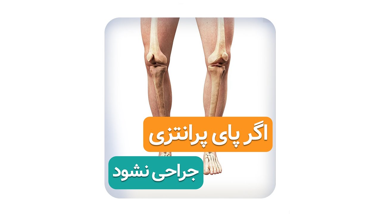 جراحی پای پرانتزی ( دکتر محمدرضا صادقی _ جراح ارتوپد )