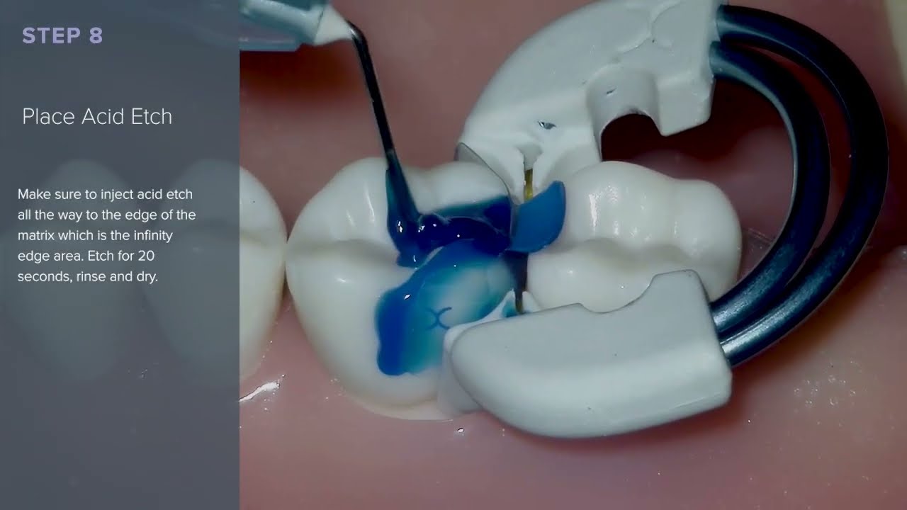 Stop Open Contacts: Bioclear Injection Moulded Class II’s Step-by-Step