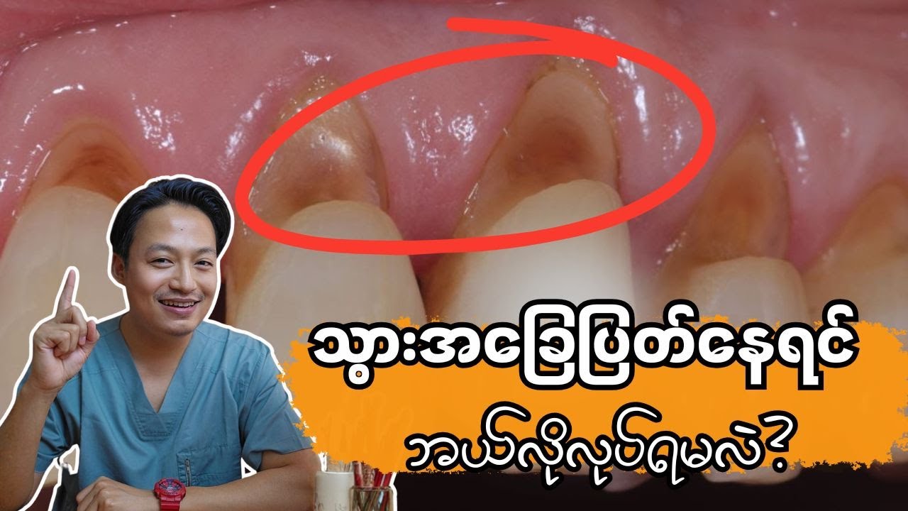 သွားအခြေပြတ်နေရင် ဘယ်လိုလုပ်ရမလဲ?