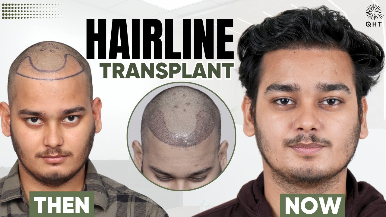 Hairline Transplant | Hairline Transplant Before & After | Hairline Transplant Results | QHT Clinic