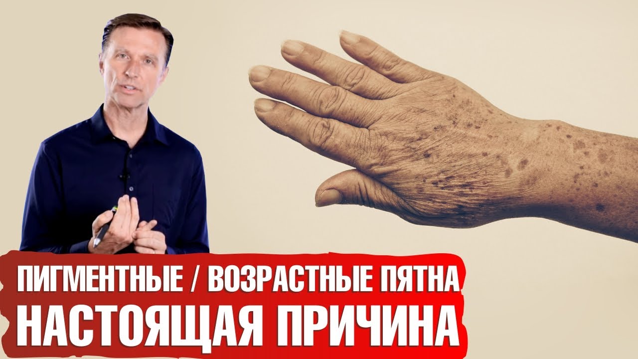 Возрастные пигментные пятна. Как избавиться от печеночных пятен