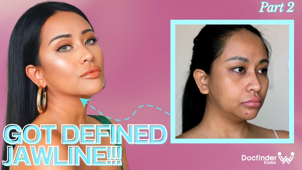 Indonesian beauty trendsetter gets BOOB JOB and ANTI-AGING surgery in Korea part 2