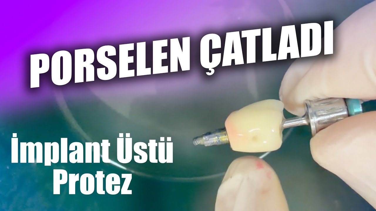 Porselen Çatladı!  İmplant Üstü Vidalı Protezler