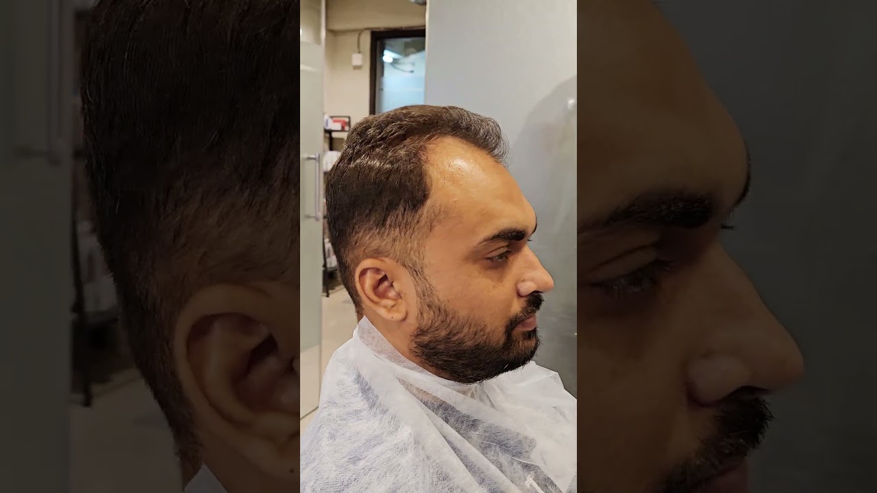 Front hair patch for men | Get Confidence with a Natural-Looking Front Hair Patch for Men #shorts