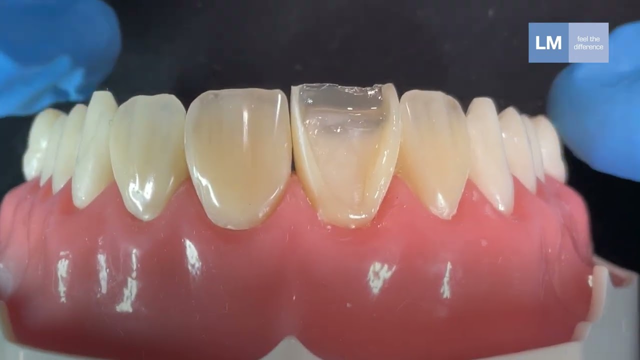 Two Shades Dentin + Enamel: case with LM-Arte™ Replica Anterior instrument