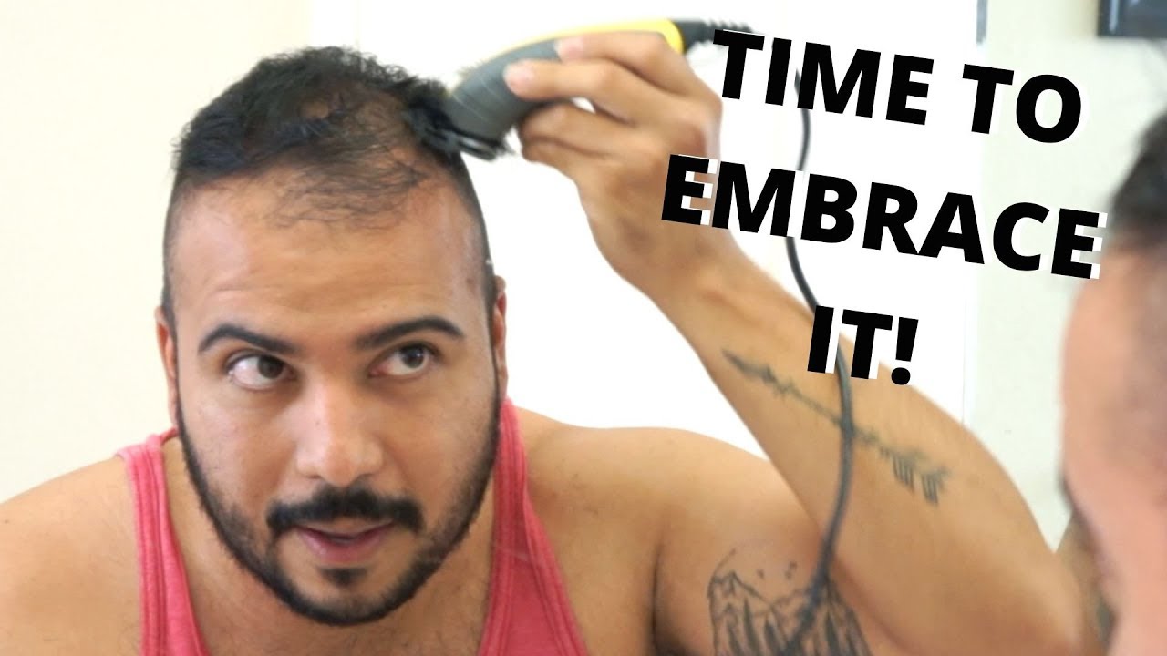 BALDING IN MY 30's - I'm Ready To Embrace Going Bald And OWN IT!