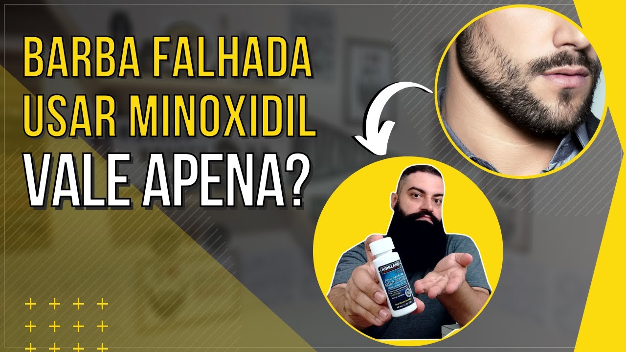 BARBA FALHADA: Tratamento Com MINOXIDIL Funciona?