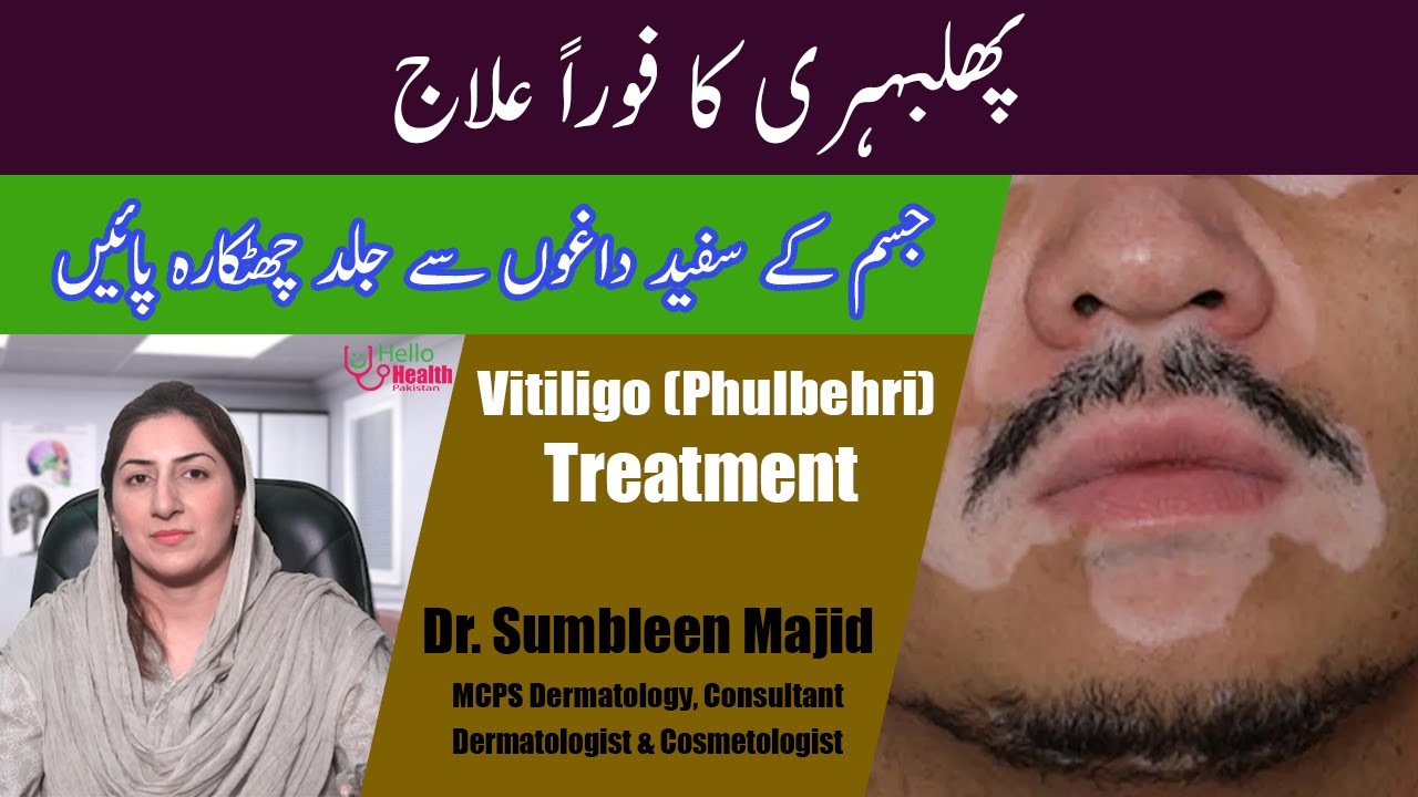 Phulbehri (Vitiligo) ka Ilaj in Urdu | Phulbehri ka fori ilaj in urdu | Dr. Sumbleen Majid