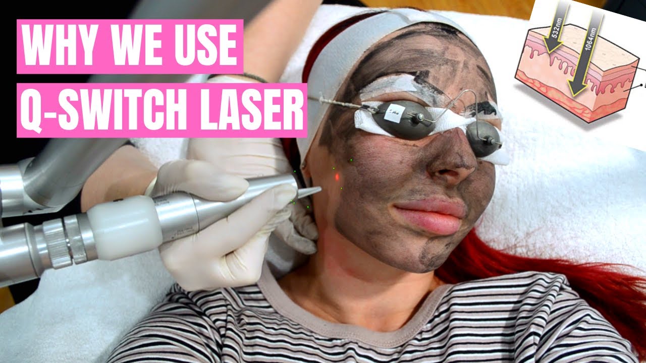 DERMAL TALKS: Why we use Q-switch Laser