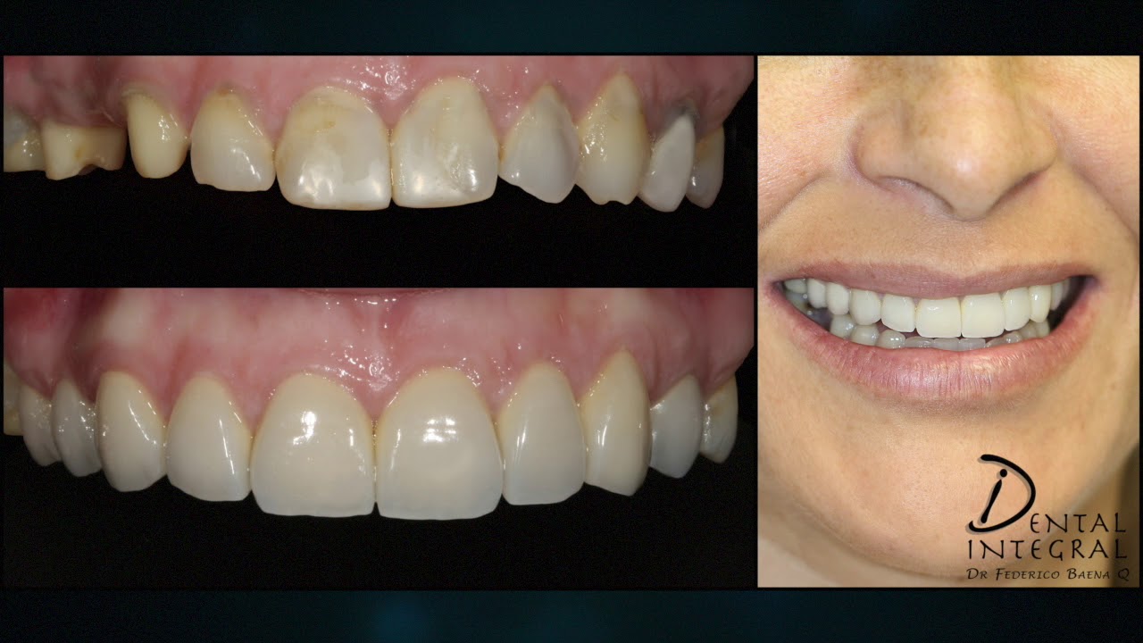 Dr. Federico Baena | Dentista Especialista en Youtube | Canal de Odontología y Salud