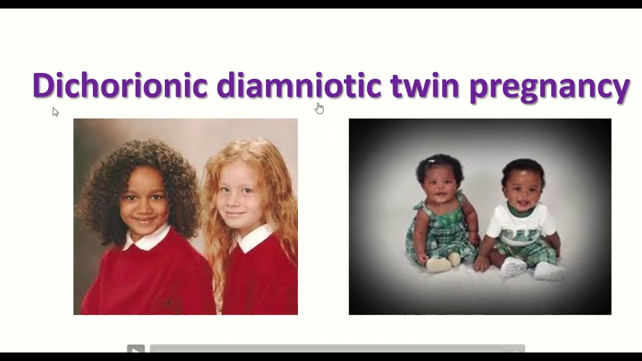 Anatomy of dichorionic and diamniotic twin pregnancy with sonographic feature