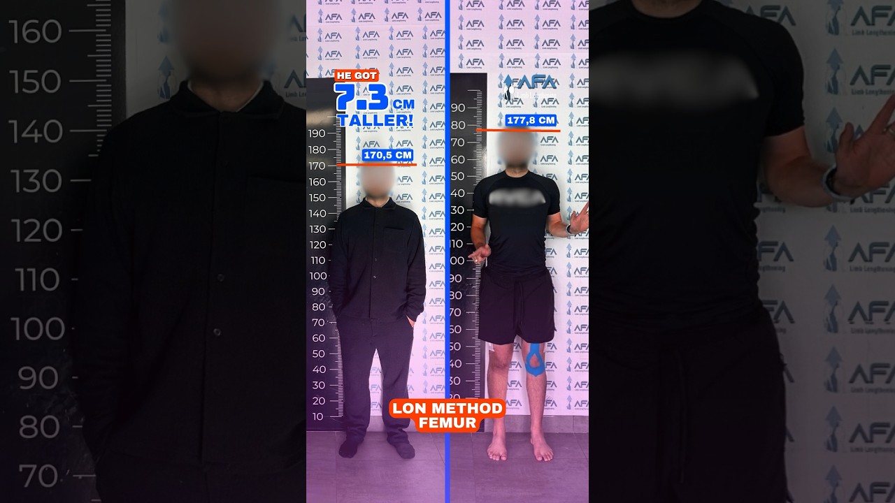 HOW DID HE GET 7,3 CM TALLER? / LON METHOD FEMUR 