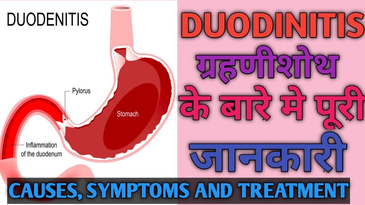 Duodinitis Details! Causes, Symptoms and treatment! ग्रहणीशोथ। Explained in detail.