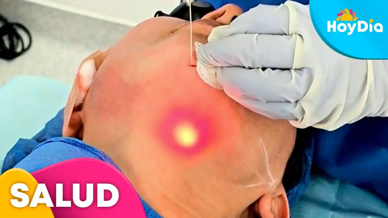 ¿El endoláser, para rejuvenecer la piel, es seguro para la salud? | Hoy Día | Telemundo