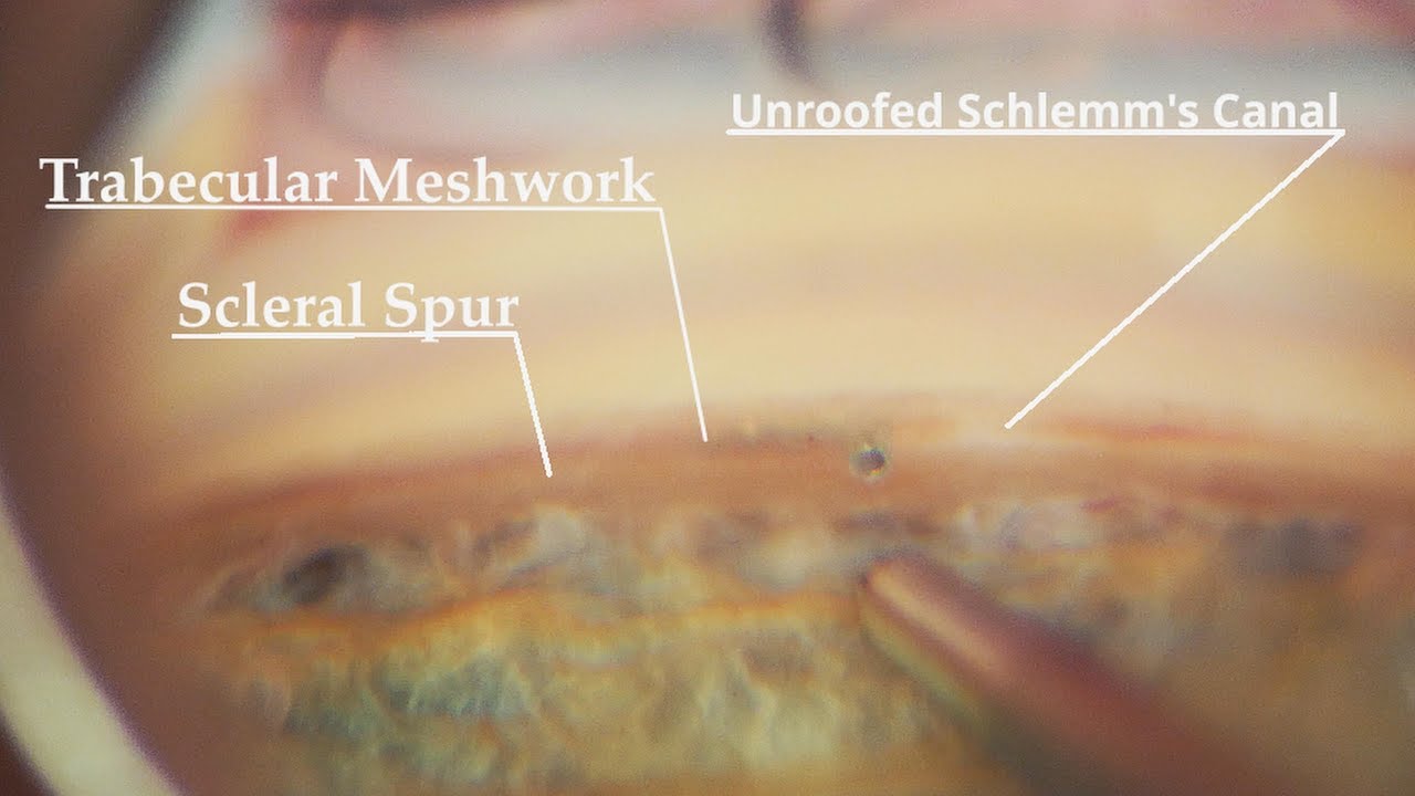 iStent insertion and MIGS surgery principles for glaucoma treatment in 4k