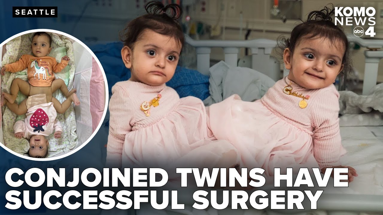 Conjoined twin girls undergo rare separation surgery at Seattle Children's Hospital
