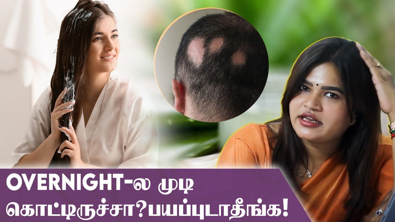 Alopecia areata-க்கு Latest Treatment இதான்! | Dr Radha Subramaniyan