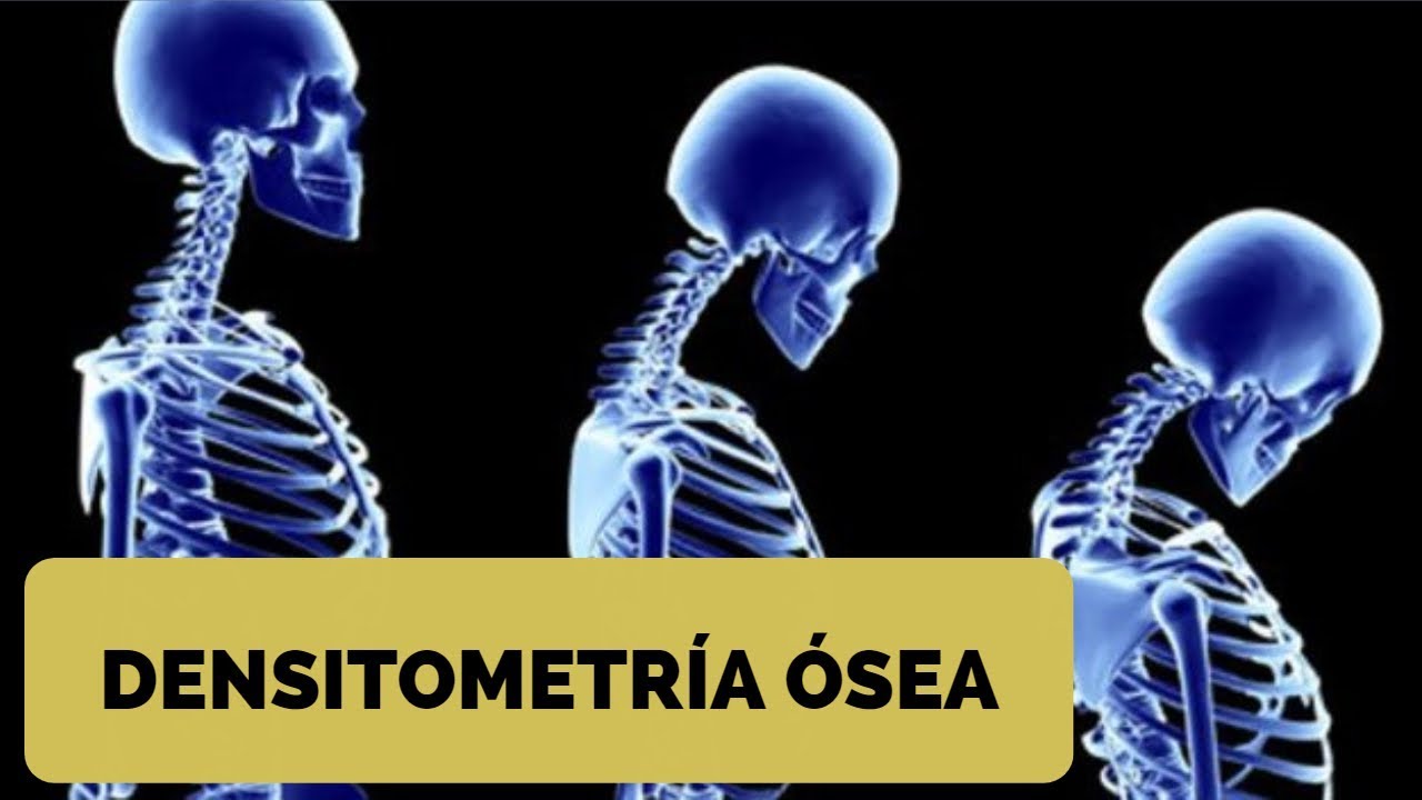 Densitrometría ósea: Interpretación clínica