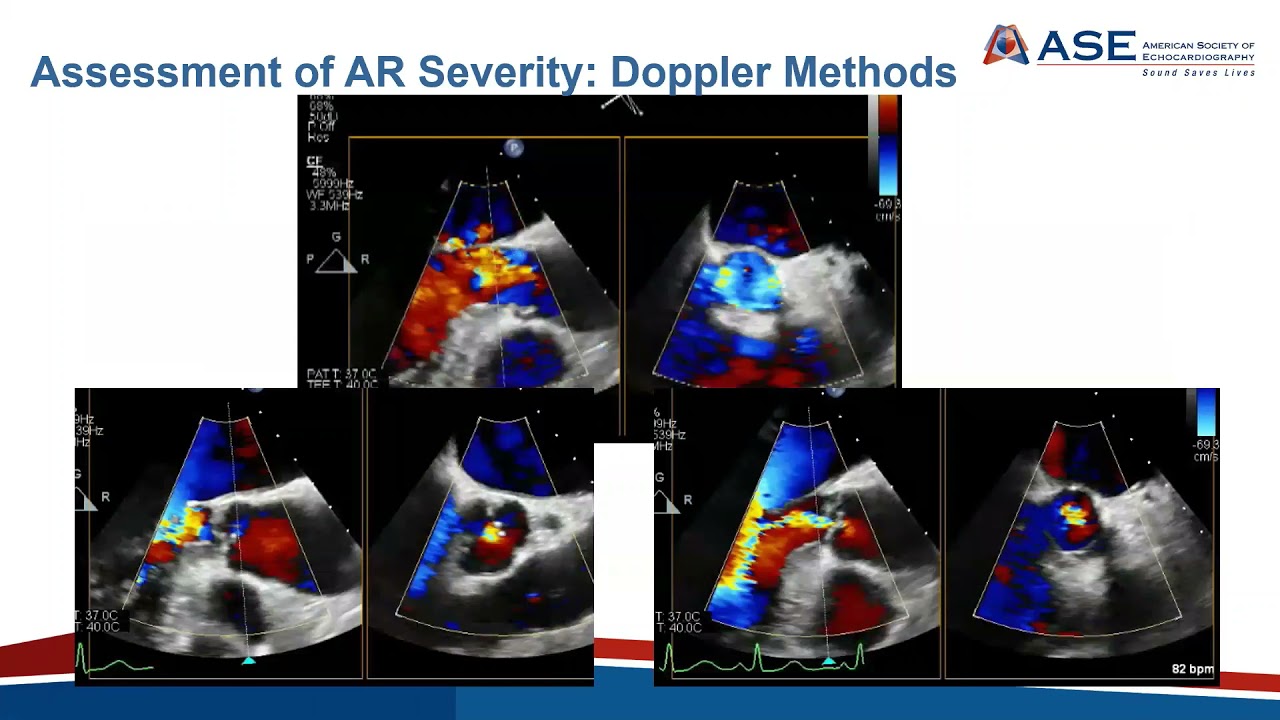 Joint Echo Conference: Aortic Insufficiency