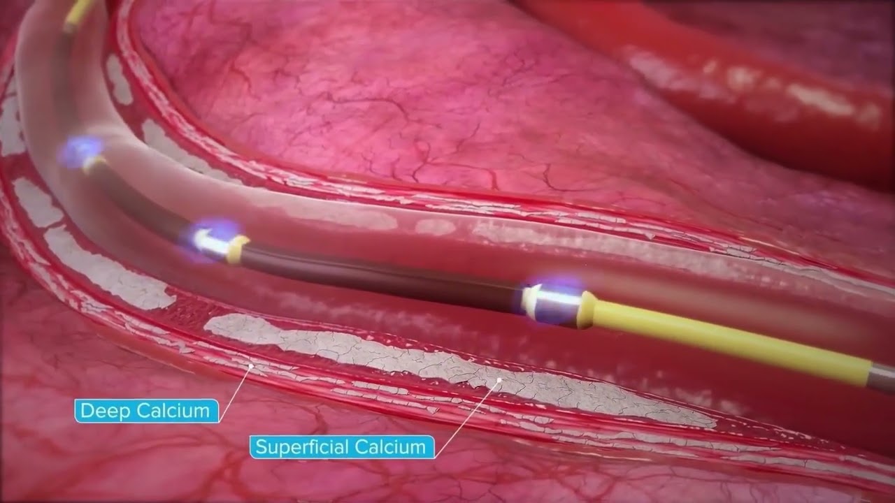 Shockwave IVL Mechanism of Action (MOA) Overview