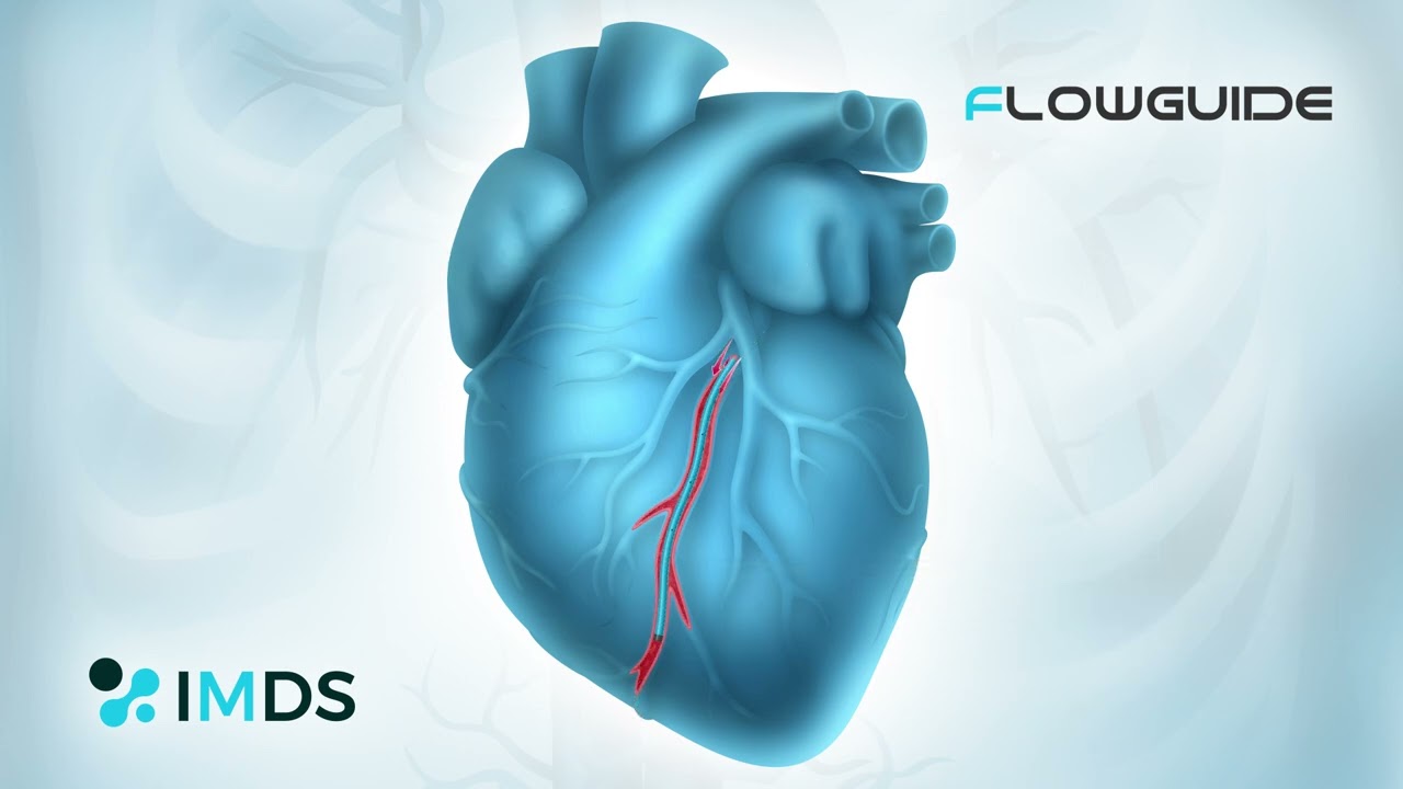 FlowGuide: The Guide Extension Catheter That Prevents Pressure Dampening in PCI