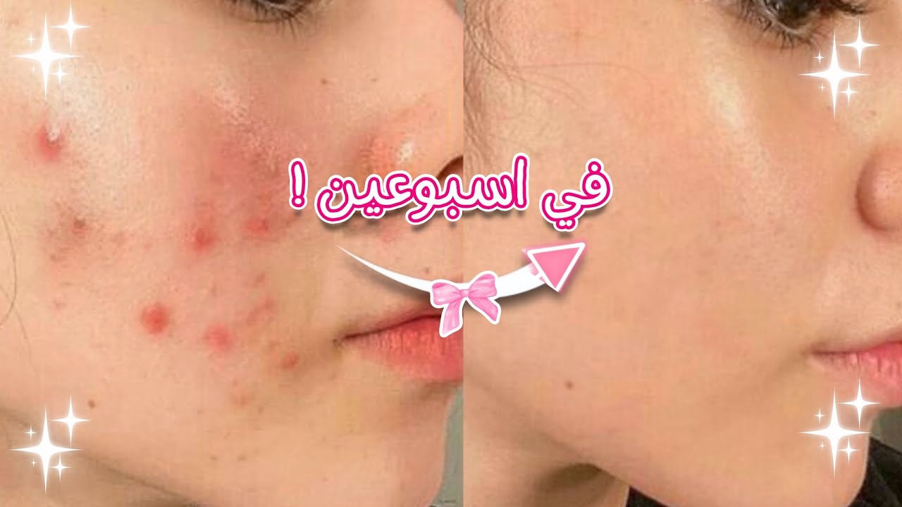 Как я вылечила все проблемы с кожей дома и без каких-либо затрат 👌💕 - ✨ Серия GLOW UP ✨