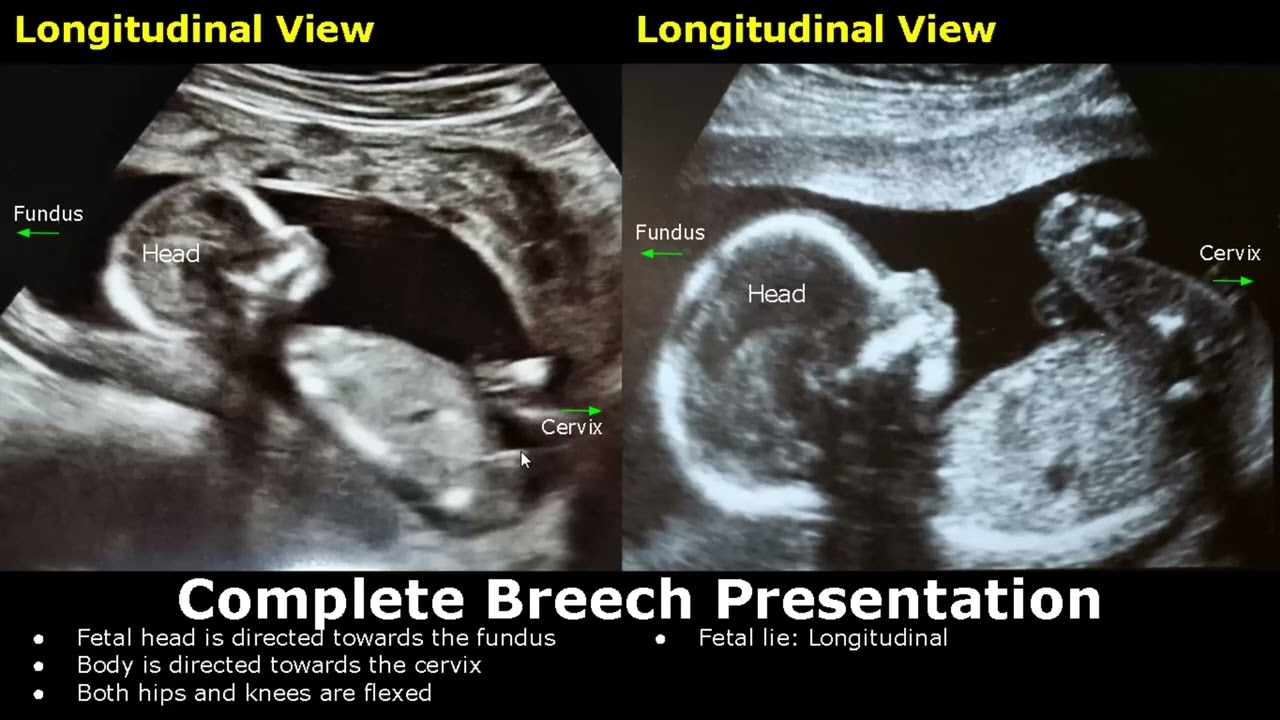 Fetal Presentations Ultrasound Images | Cephalic/Breech/Frank/Footling/Funic Fetus | Fetal Lie USG