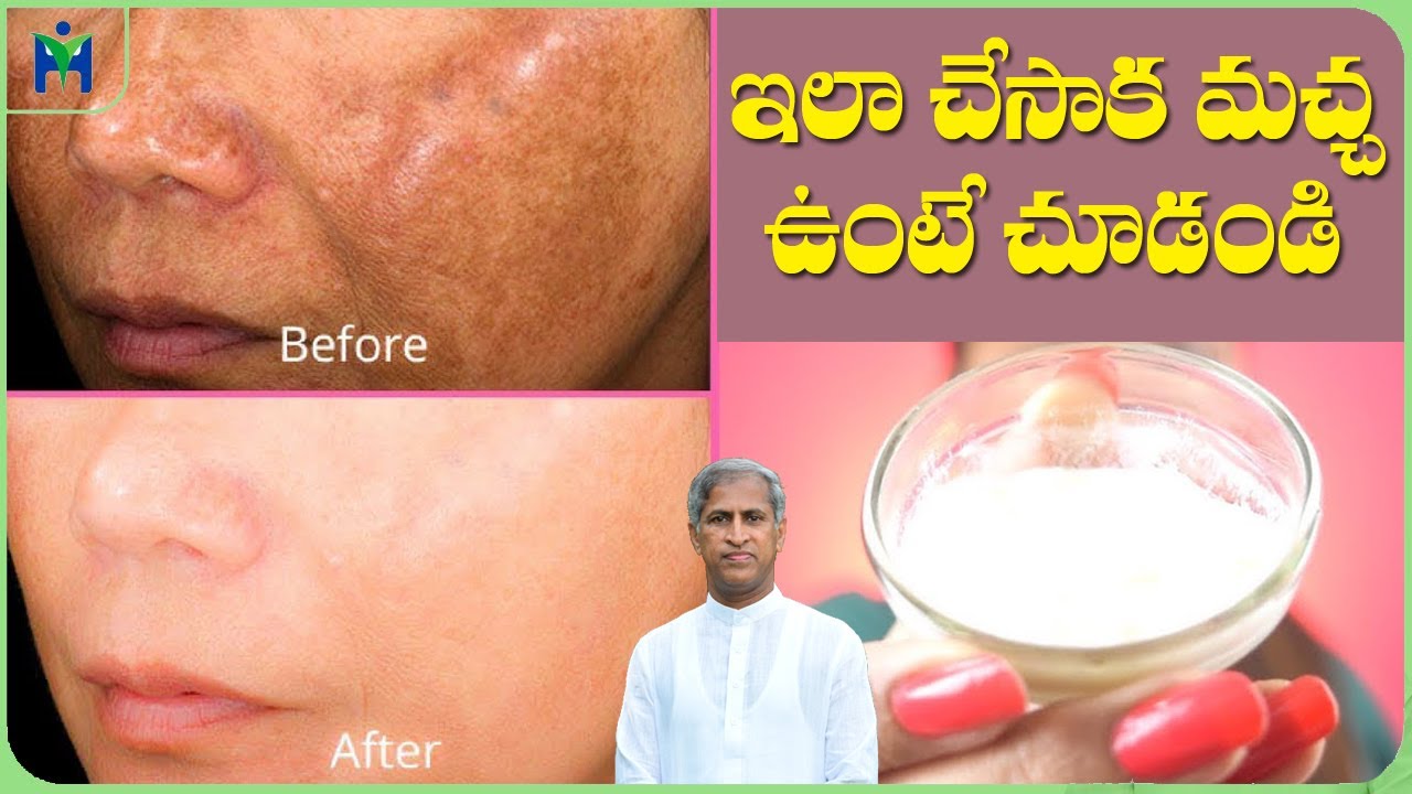 Home Remedies for Pigmentation: How to Remove Dark Spots | Dr Manthena Satyanarayana Raju Videos
