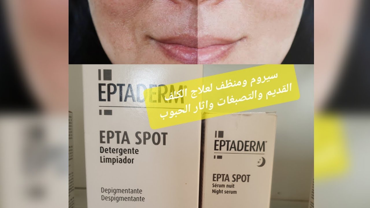 روتين جد فعال لعلاج الكلف القديم والتصبغات وأثار الحبوب👈 eptaderm epta spot serum et gel nettoyant 👍
