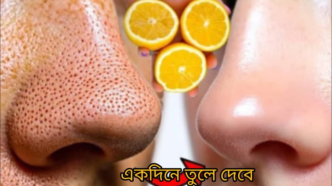 Remove BLACKHEADS WHITEHEADS CLOGED PORES Naturally|Permanent Results |Get Smooth Glowing Skin😱