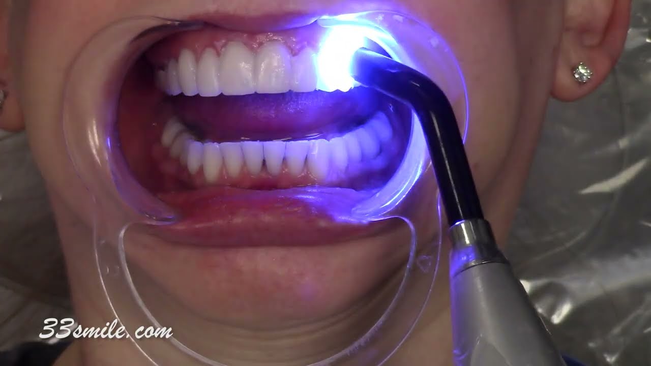 Cosmetic Dentistry Before and After Prepless Veneers. Teeth Stained.