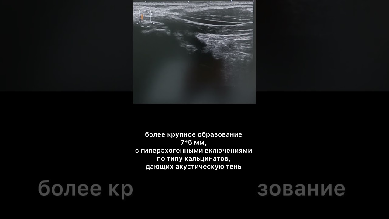 #TIRADS5 #АРМДиАссистент #УЗИщитовидной железы