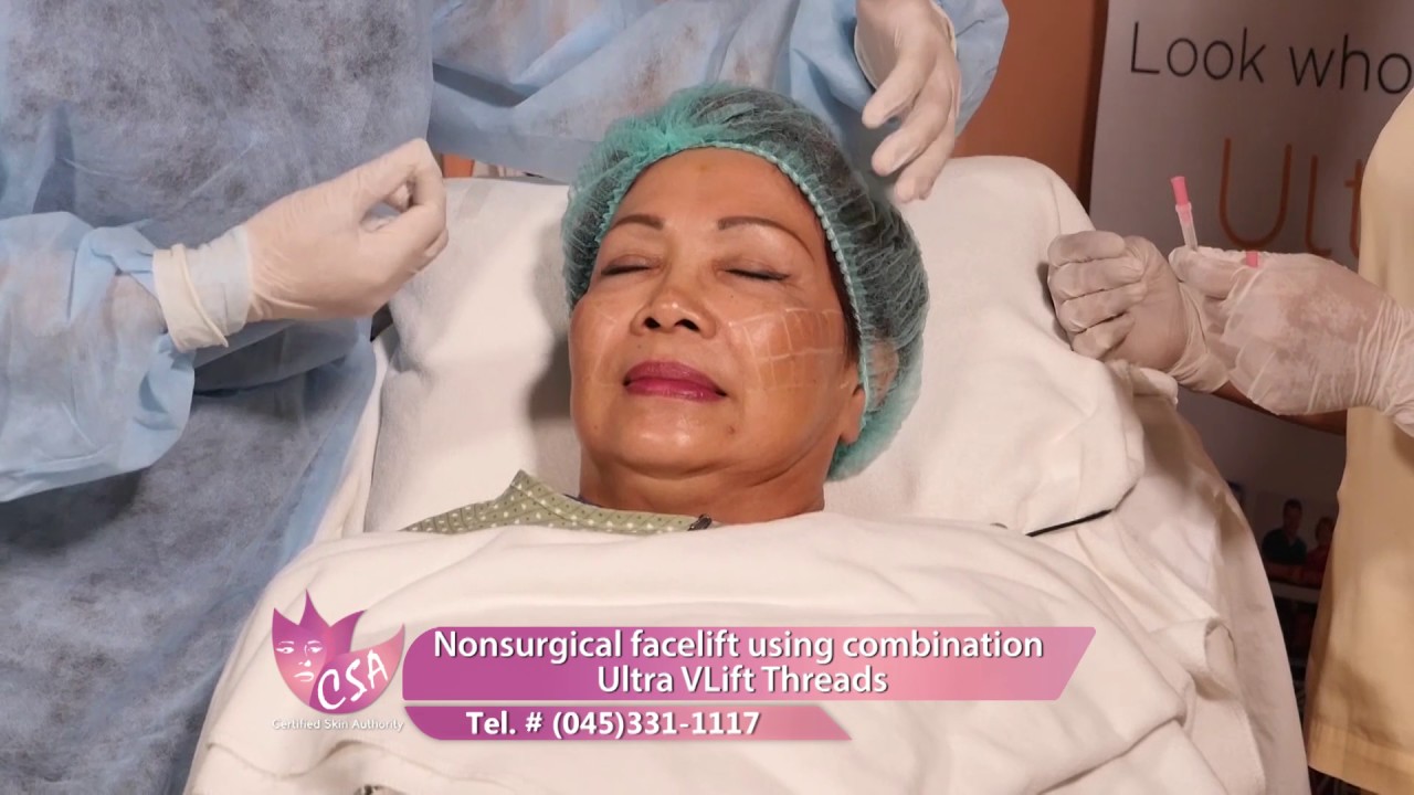 Nonsurgical facelift using combination Ultra Vlift Threads