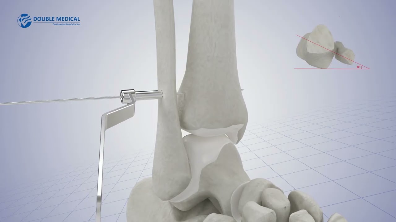 CF Loop Adjustable | Knotless, Stable, and Durable Fixation for Ankle Surgery