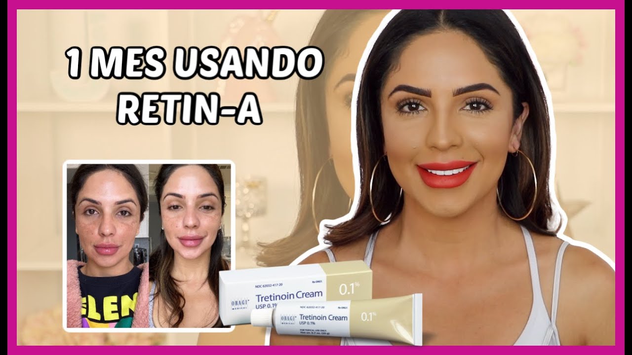 1 MES USANDO RETIN-A. QUE CAMBIOS EH NOTADO? LO BUENO, LO MALO Y SUS EFECTOS.