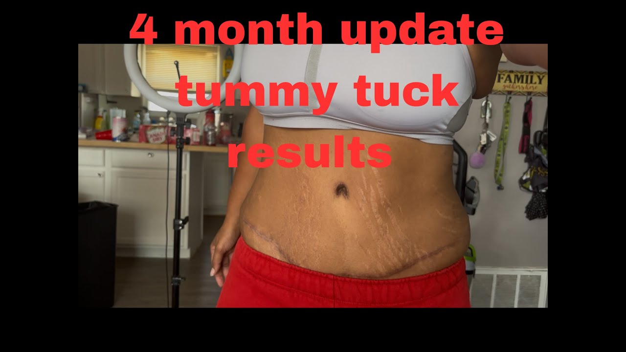 4 Month Tummy Tuck Update | My Honest Results 👙