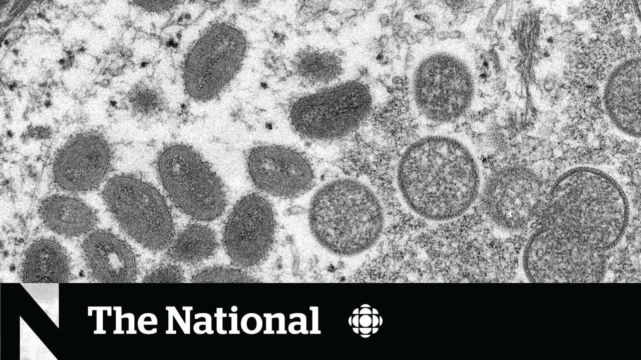 Monkeypox cases, transmission under investigation in Canada