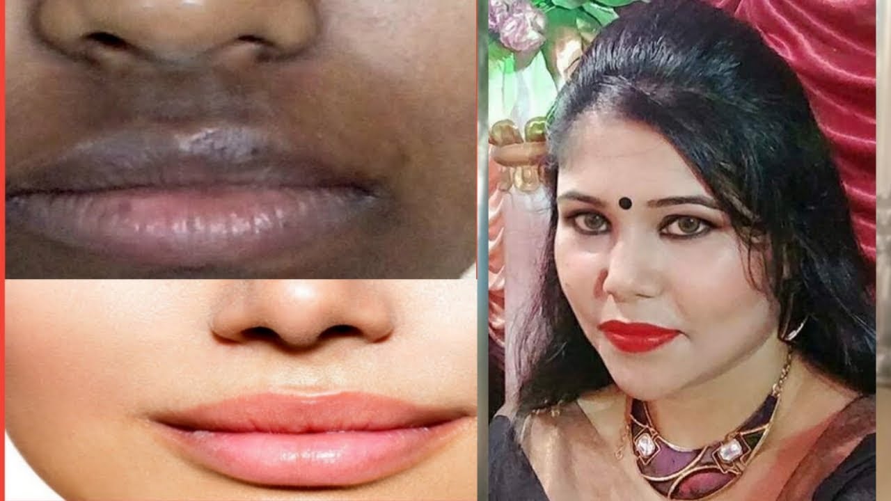 (30 Days Challenge) Remove Dark spots, Black spots & Acne Scars - Natural Beauty by Moumita